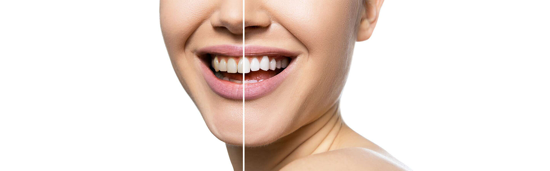 Teeth Whitening in Plymouth, NH